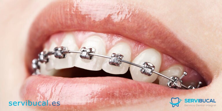 brackets en dientes superiores en consulta dental