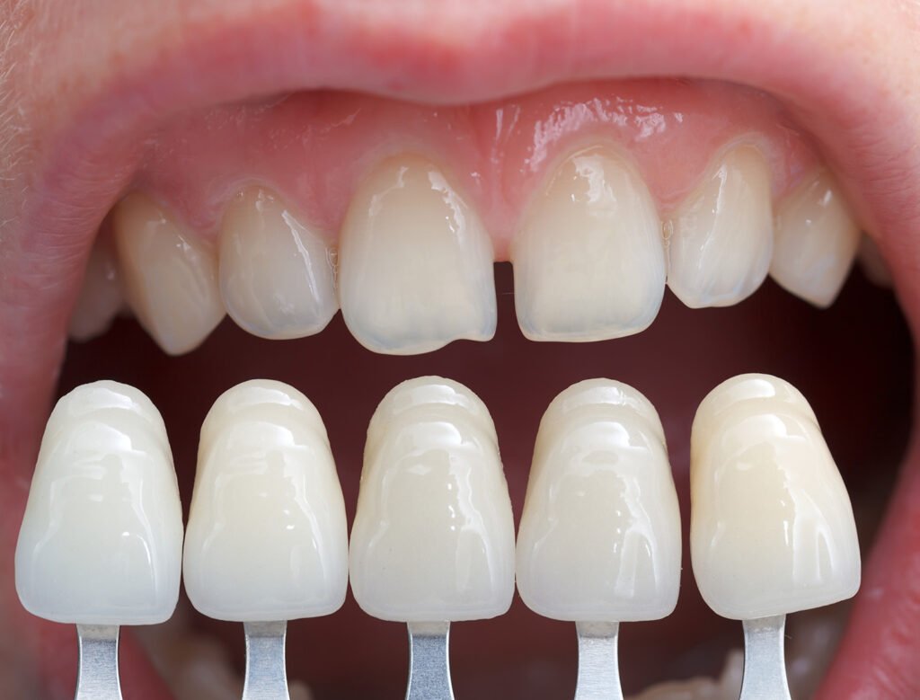 Qué tipo de carillas elegir: composite o porcelana para tus dientes
