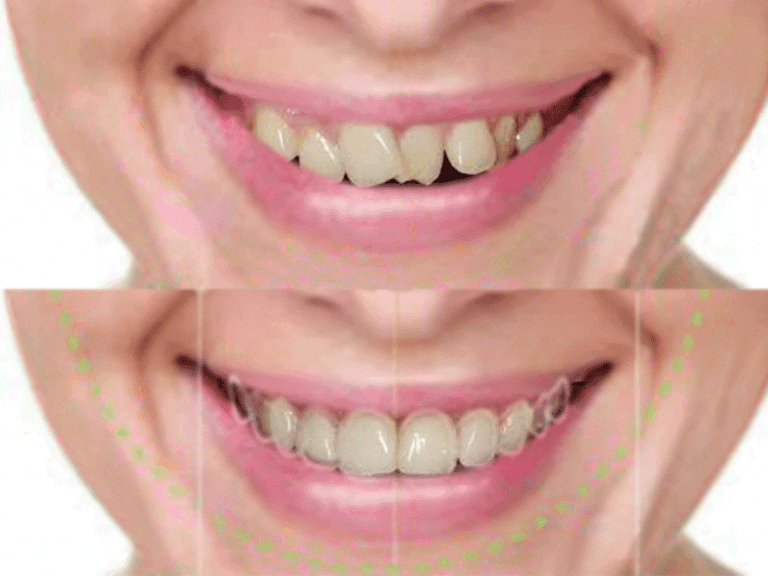 comparativa de sonrisas antes y despues 1