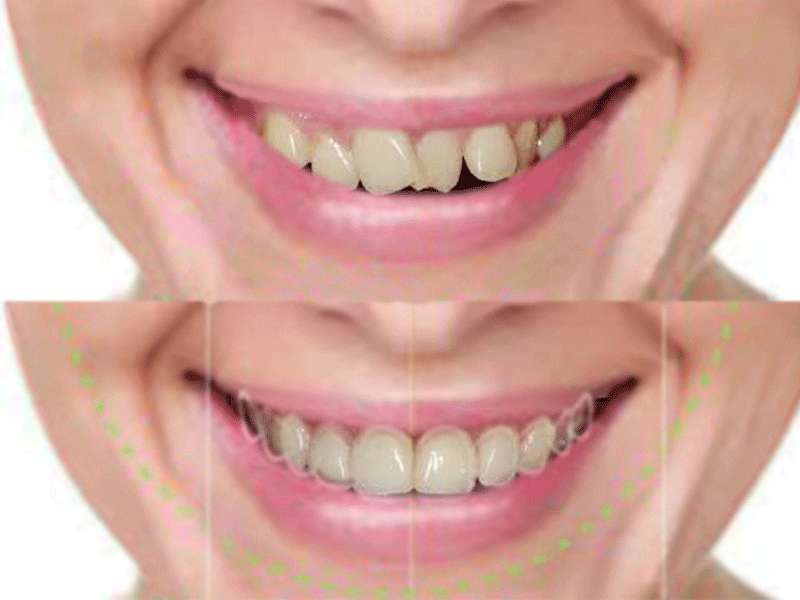 Cómo luce el diseño de sonrisa en fotos de antes y después