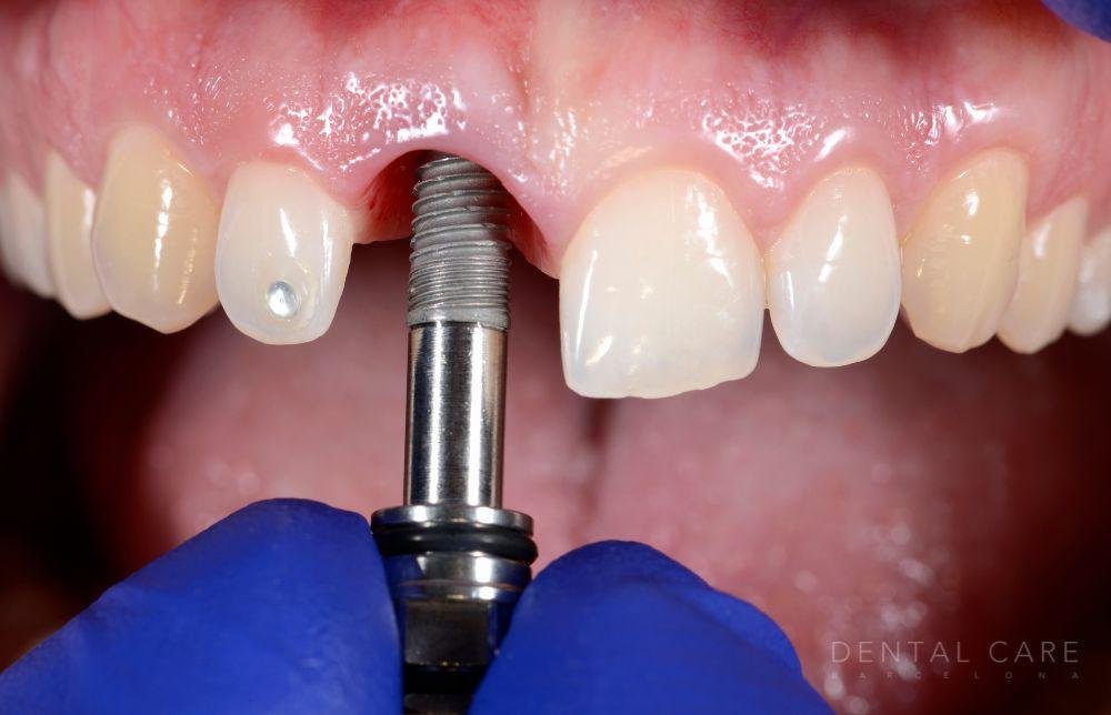 El seguro dental cubre los costos de implantes dentales en Argentina