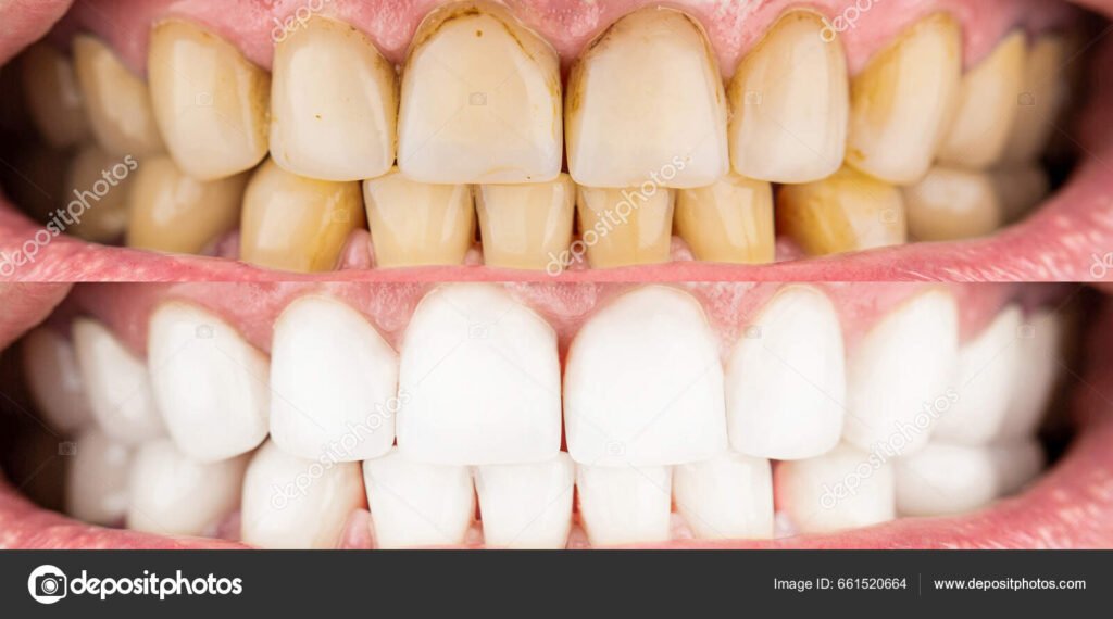 Por qué tengo los dientes amarillos a pesar de cepillarlos regularmente