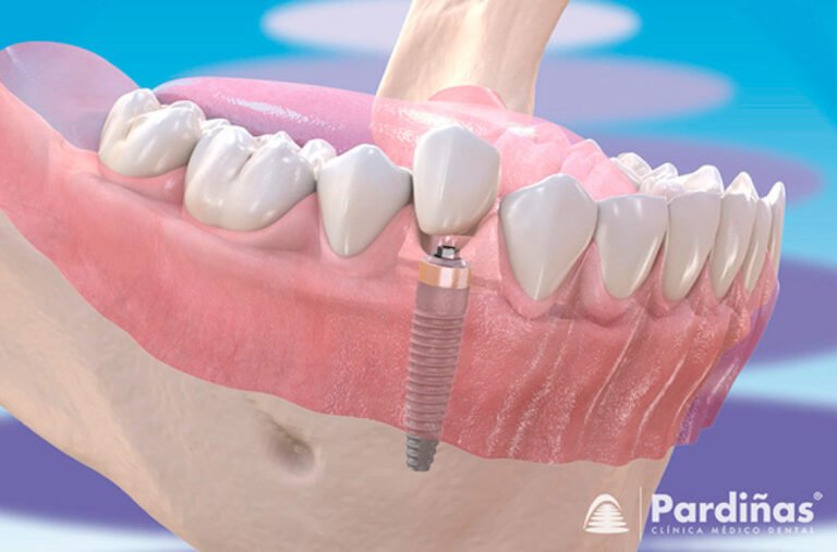 dientes en reparacion dental con herramientas