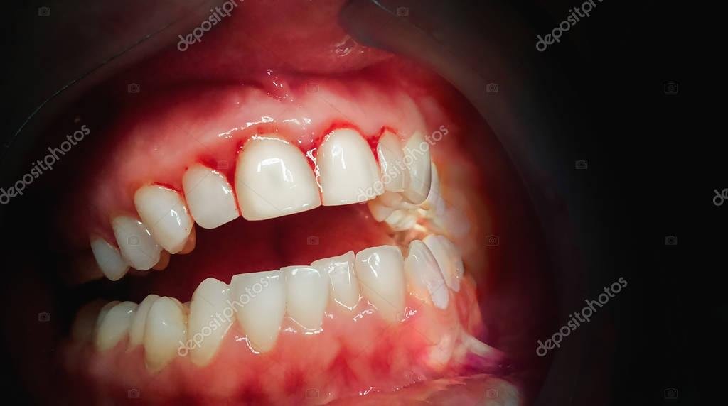 Qué Significa Soñar con Dientes Rotos y Su Interpretación Psicológica