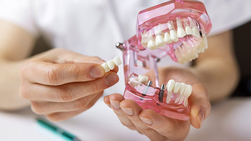 Qué Consecuencias Puede Tener Quitar un Implante Dental 4 Qué Consecuencias Puede Tener Quitar un Implante Dental
