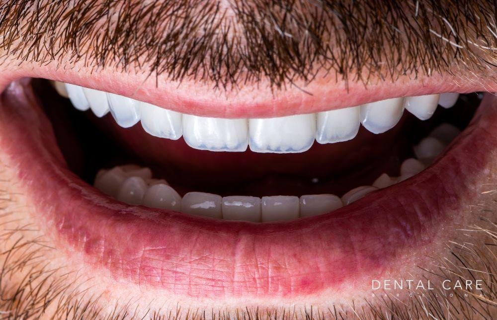 Qué es una lámina de porcelana y cómo se coloca en los dientes