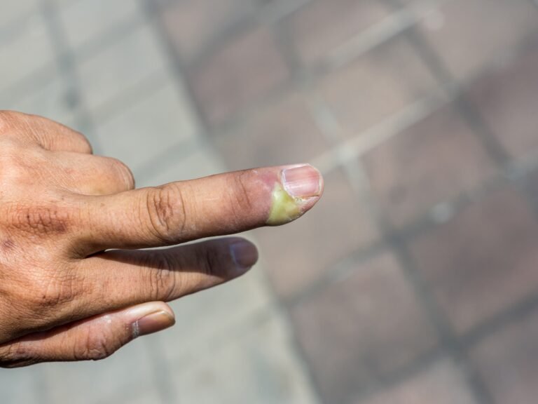 mano con dedos mordidos y cuidados