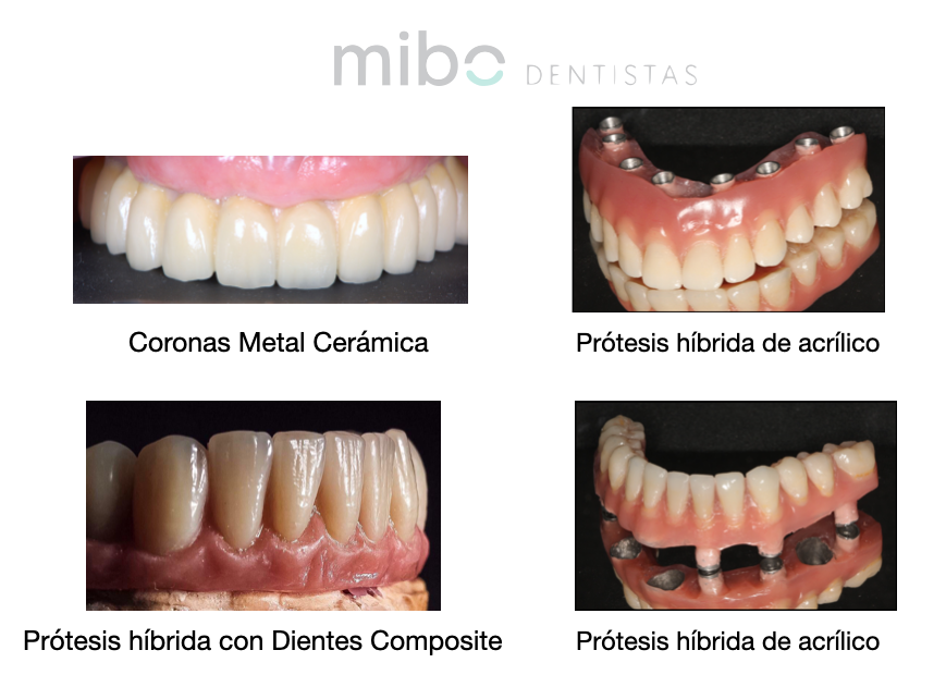Cuáles son las diferencias entre prótesis de porcelana y prótesis híbrida sobre implantes 4 Cuáles son las diferencias entre prótesis de porcelana y prótesis híbrida sobre implantes