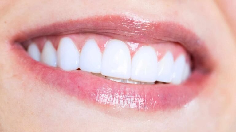 sonrisa brillante con carillas de composite