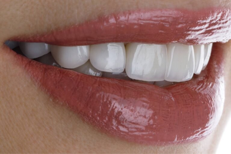 sonrisa brillante con carillas dentales