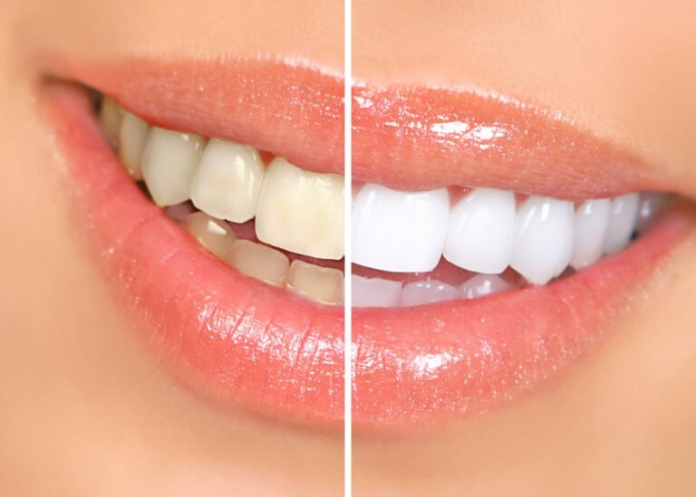 Cuáles son los pros y contras del blanqueamiento dental 25 sonrisa brillante y dientes blanqueados